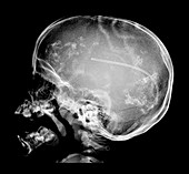 Neonatal CMV Infection, Skull X-ray