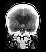 Imaging of Colloid Cyst, CT