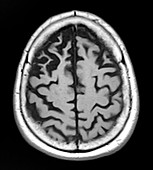 Frontal Temporal Dementia, MRI