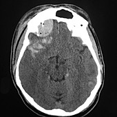 Traumatic Brain Injury, CT