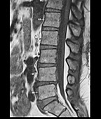 Epidural Lipomatosis, MRI