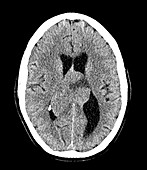 Glioblastoma, CT