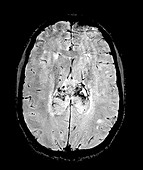 Glioblastoma, MRI