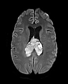 Glioblastoma, MRI