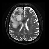 Frontal Lobe Glioblastoma, MRI