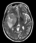 Temporal Glioblastoma, MRI