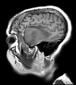 Temporal Glioblastoma, MRI