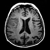 High Grade Glioma, MRI