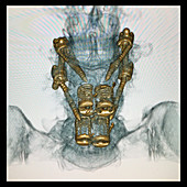 Lumbar Spinal Instrumentation, 3D CT