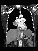 Lung Cancer, CT