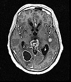 Metastatic Lung Cancer to Brain, MRI