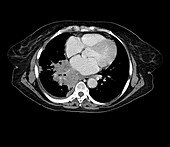 Lung Cancer, CT