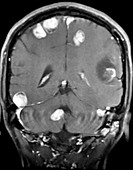 Melanoma Metastatic to Brain, MRI