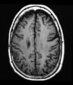 Small Meningioma, MRI