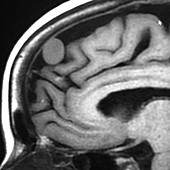 Frontal Meningioma with Path, MRI