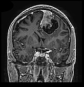 Cystic Meningioma, MRI
