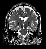 Mesial Temporal Sclerosis, MRI