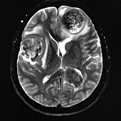 Metastatic Disease to Brain, MRI