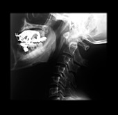 Old Non-union Type II Odontoid Fracture, X-ray
