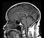 Olfactory Groove Meningioma, MRI