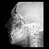 X-Ray of Skull and Face