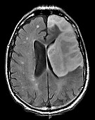 Haemorrhagic Stroke, MRI