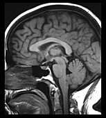 Subependymoma, MRI