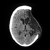 Sunken Flap Syndrome, CT