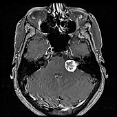 Vestibular Schwannoma, MRI