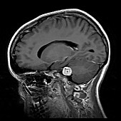 Vestibular Schwannoma, MRI