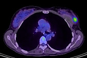 Carcinoma in patient with breast implants, PET CT scan