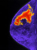 Breast Cancer, MRI