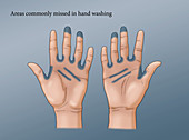 Missed Areas in Hand Washing, illustration