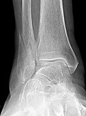 Acute Spiral Fracture, X-ray