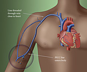 PICC intravenous device, illustration