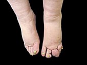 Macrodactyly of the feet