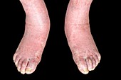 Foot ulcers