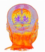 Visual cortex in the brain, coronal MRI scan