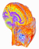 Brain and spinal cord, 3D MRI scan