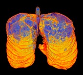 Smoker's lungs and emphysema, 3D CT scan
