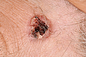 Squamous and basal cell carcinomas after treatment