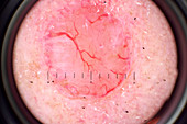 Trichoblastoma examination