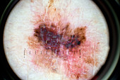 Malignant melanoma examination