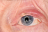 Chalazion abscess on an eyelid