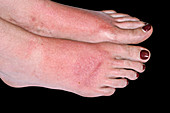 Sunburn on the feet