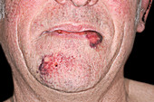 Contusions to the mouth after an assault
