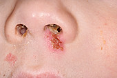 Impetigo infection on nose
