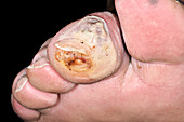 Diabetic ulcer on toe