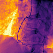 Coronary angiogram stenosed artery