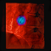 Stent to treat a blockage of the coronary arteries